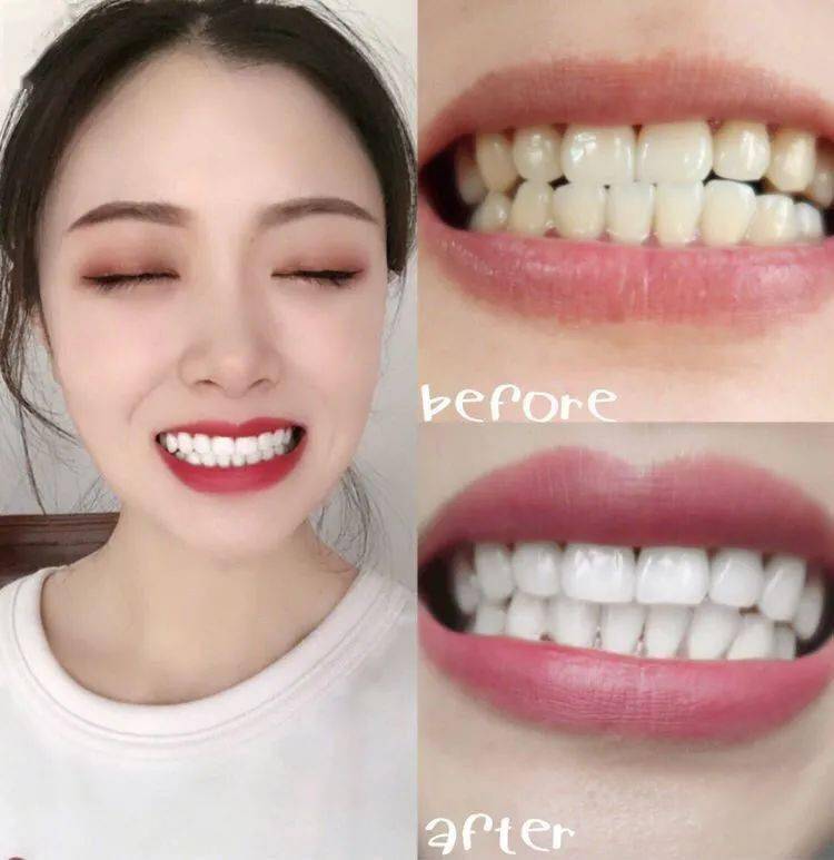 清洁|电动牙刷真的比普通牙刷好吗？我替你们问了医生