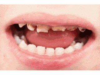 清洁|电动牙刷真的比普通牙刷好吗？我替你们问了医生