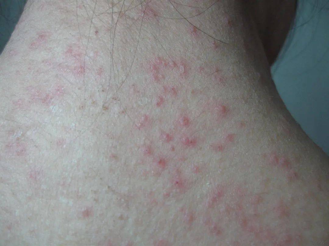 秋季皮肤瘙痒,起红疹,这是怎么回事?
