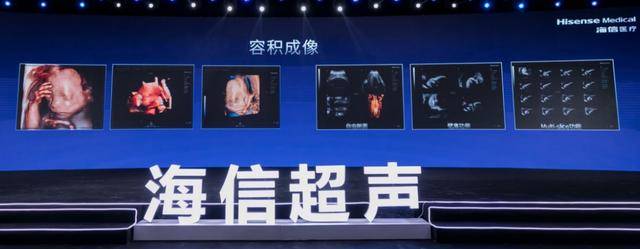 台超声|运算能力较传统方案提升一倍 海信首台超声产品正式发布