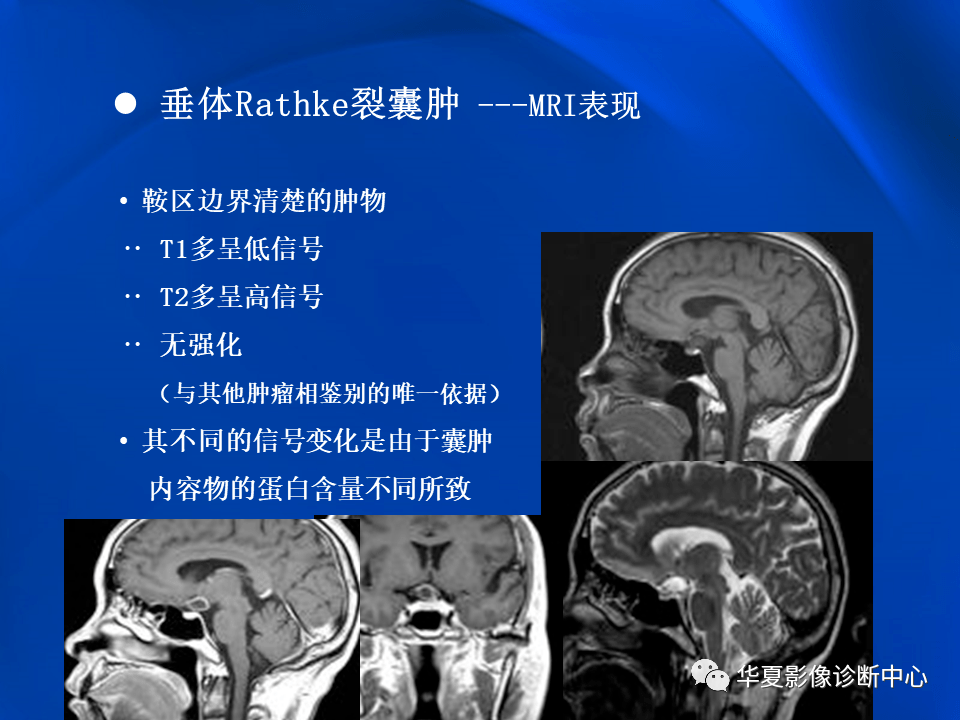 垂体rathke裂囊肿mr表现