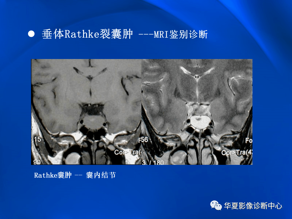 垂体rathke裂囊肿mr表现