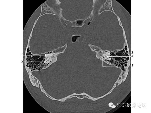 8后半规管 9岩鳞隔 10乳突窦4前庭导水管 5前庭 6窦入口 7外半规管1面