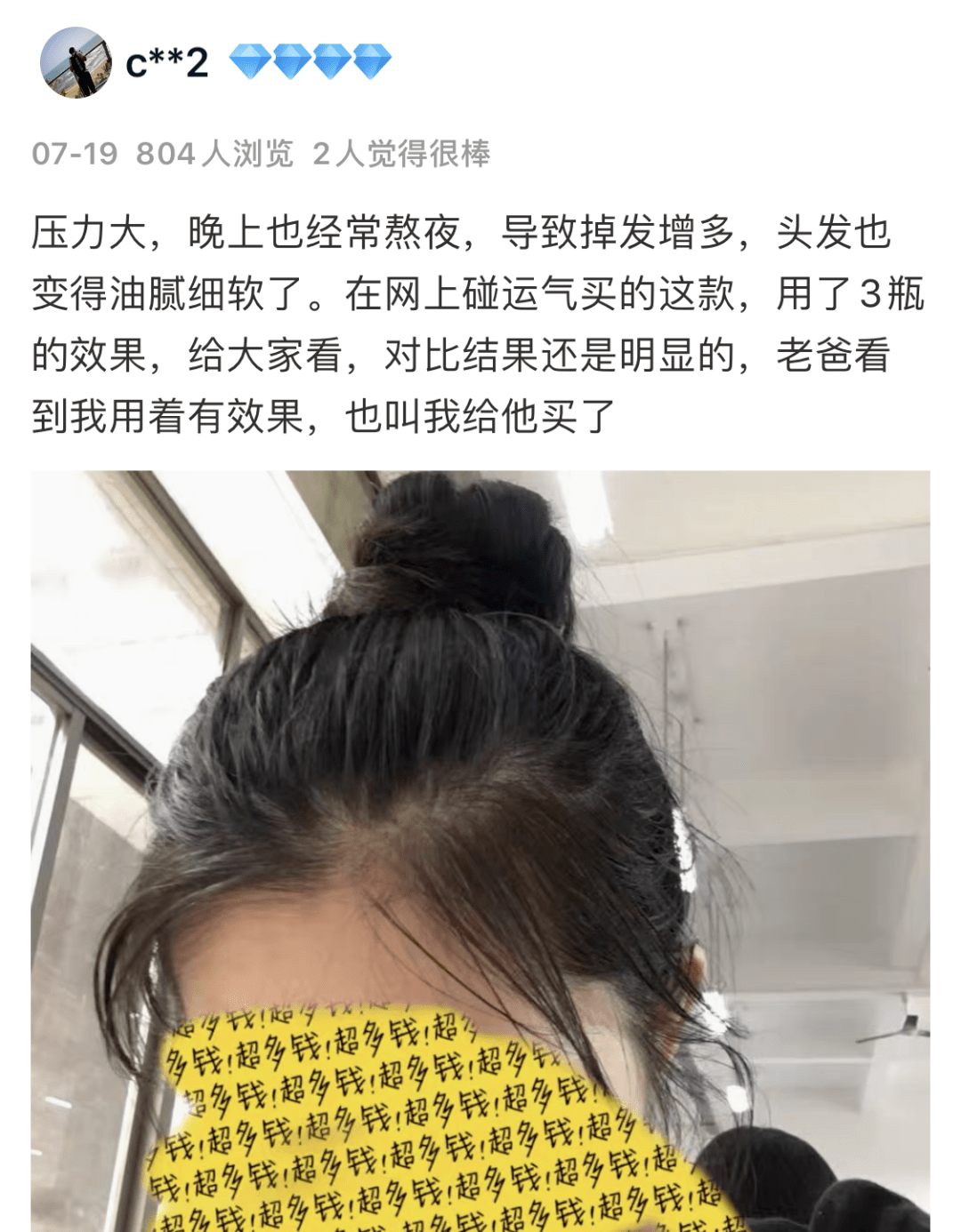 毛囊|流女星们的“狮子头”都是假象？录节目竟然当场掉下假发片，真相竟然是……