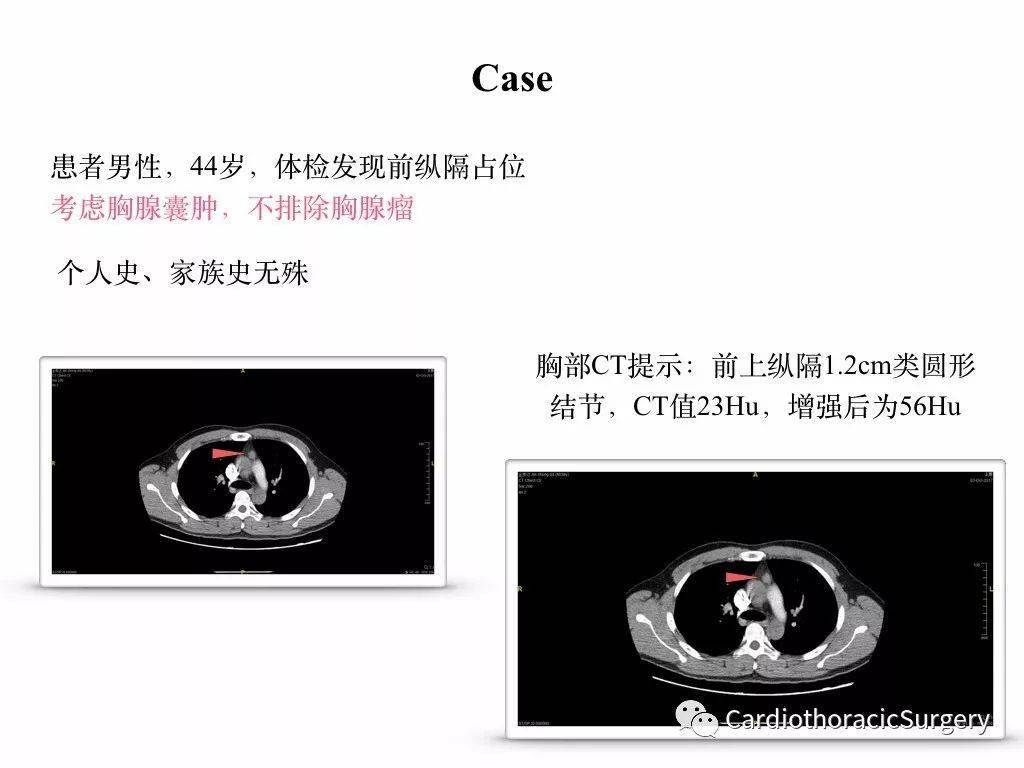 前纵隔小胸腺瘤—困难决策