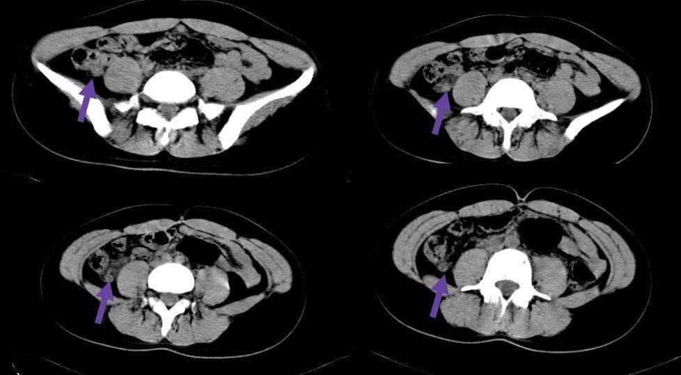 片上|CT 片上总是找不到阑尾？3 步法教你快速定位