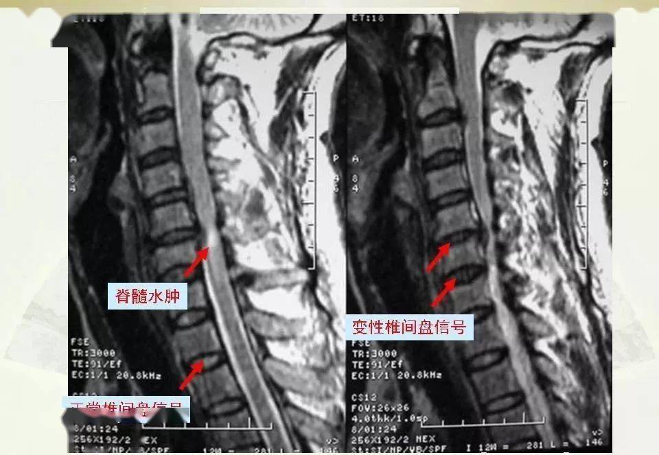 详细颈椎x线解读及关于颈椎病的影像学诊断及分型汇总