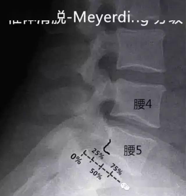 骶椎腰化/腰椎骶化,腰椎滑脱,腰肌劳损,简单易懂图解!