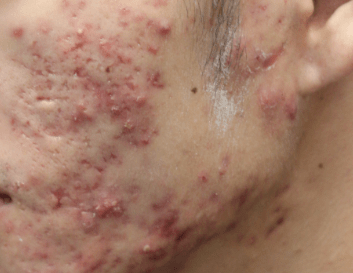青春痘的皮肤表现有哪些呢?