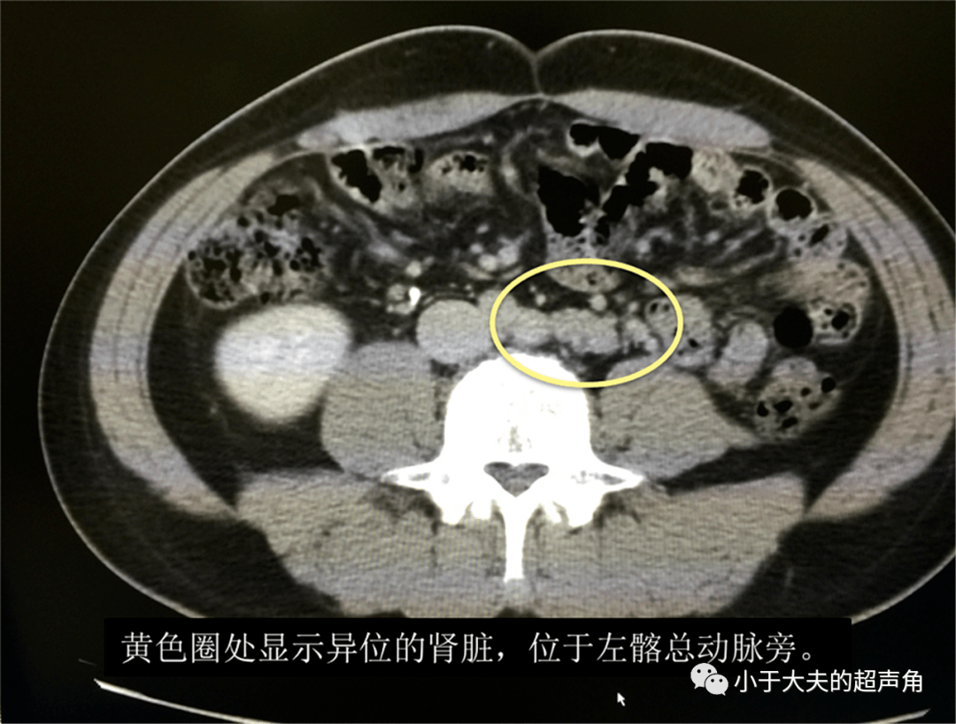 诊断|【超声随响】第21期 肾脏先天性发育异常 诊断肾缺如要谨慎!