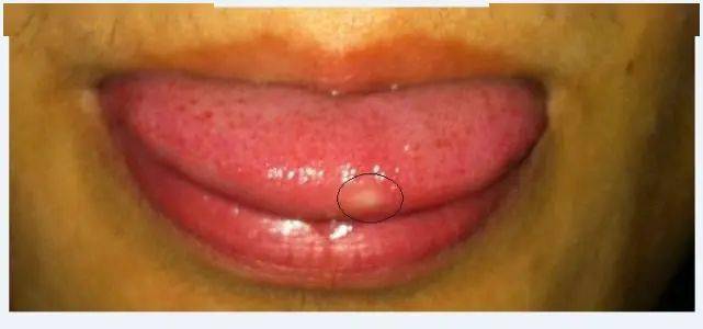 舌痛一般有两种原因,一种是  舌头组织有病变,另一种是  心理因素