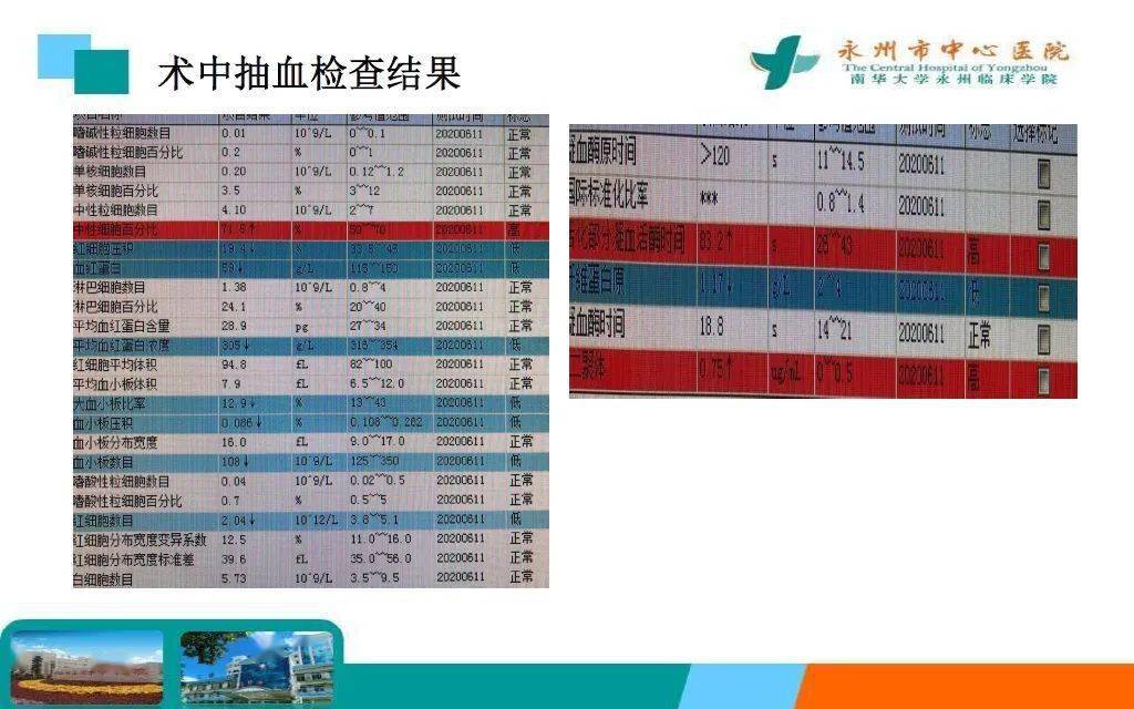 患者|病例分享 | 术中凝血功能障碍一例