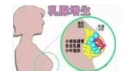 什么是乳腺增生症