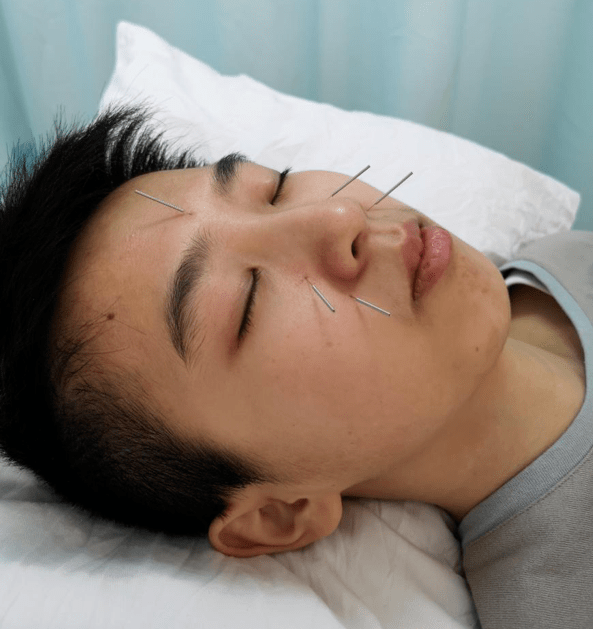 广州中医药大学靳瑞教授总结,创造出的一套治疗过敏性鼻炎的针灸方法