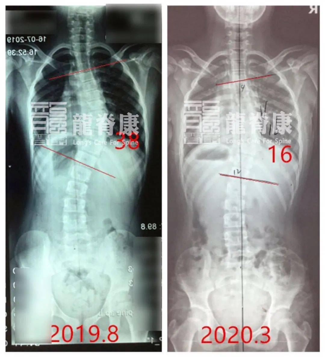 病例9岁女孩脊柱侧弯38半年内减至16