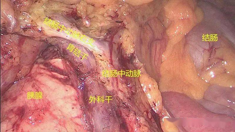 图解腹腔镜右半结肠 henle 干解剖