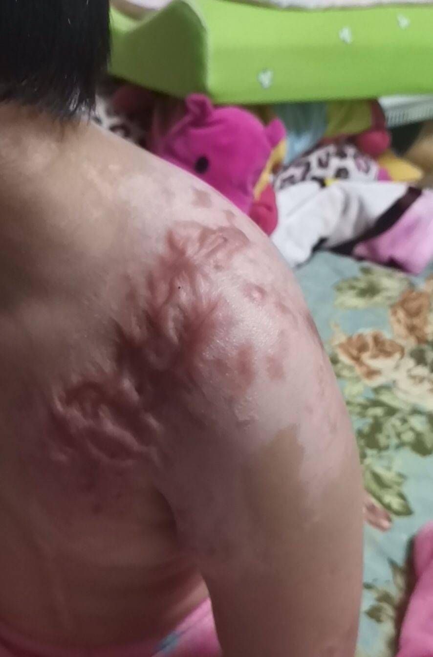 医生在遭生母与男友虐待女童腿上取出钢针