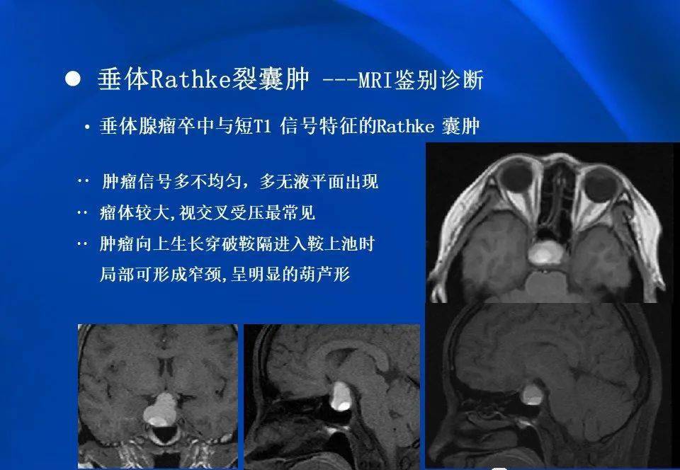 【影像】拉克氏囊肿的mri表现及鉴别诊断