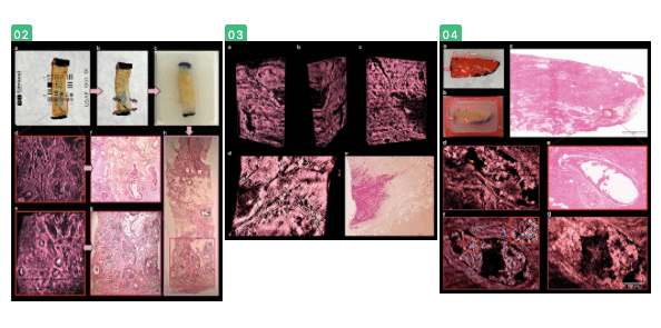 组织|【新技术】3D肿瘤显微镜可对肿瘤组织进行三维角度分析，简化肿瘤诊断！价格便宜易操作！