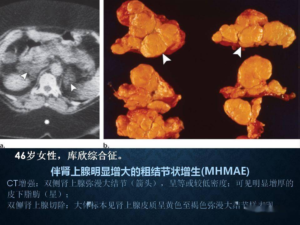 肾上腺丨扫描方案,解剖,皮质增生及小腺瘤的诊断