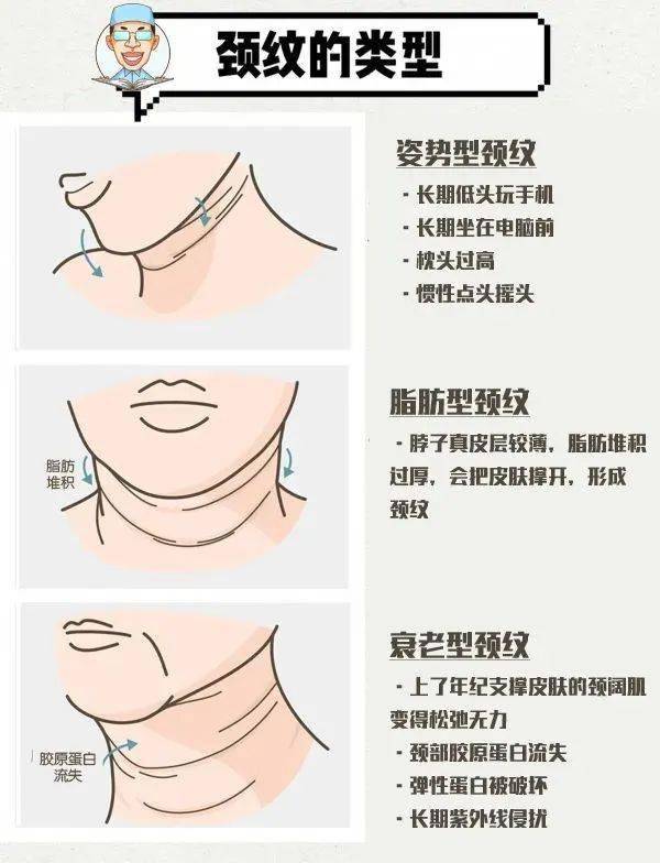 颈纹的形成原因及治疗方法