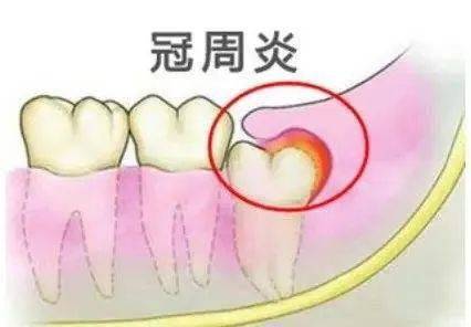 牙疼可能不是发炎,12种牙疼你属于哪种?