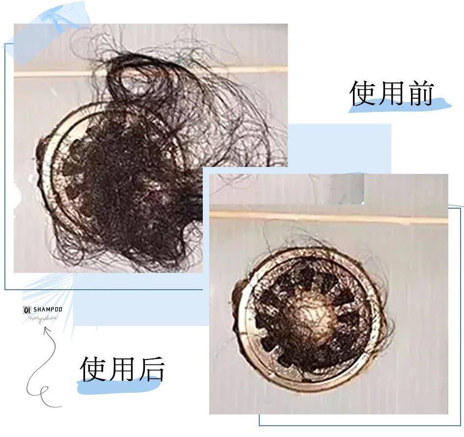 克兰|头上抠下的“白泥”，居然不是头皮屑？脱发头油都是因为它？