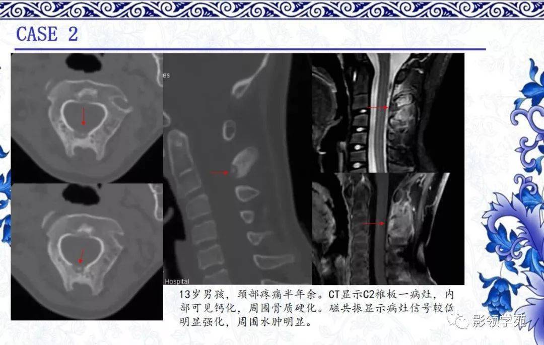 经典常见骨源性肿瘤的影像表现