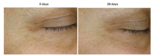 鱼尾纹|黑眼圈、肿眼泡、鱼尾纹，眼睛到底有多暴露年龄？