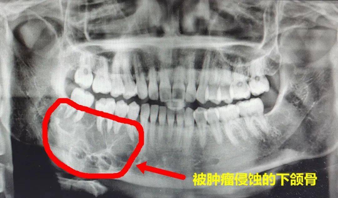 然而,天有不测风云,年纪轻轻的她不幸罹患了下颌骨肿瘤.