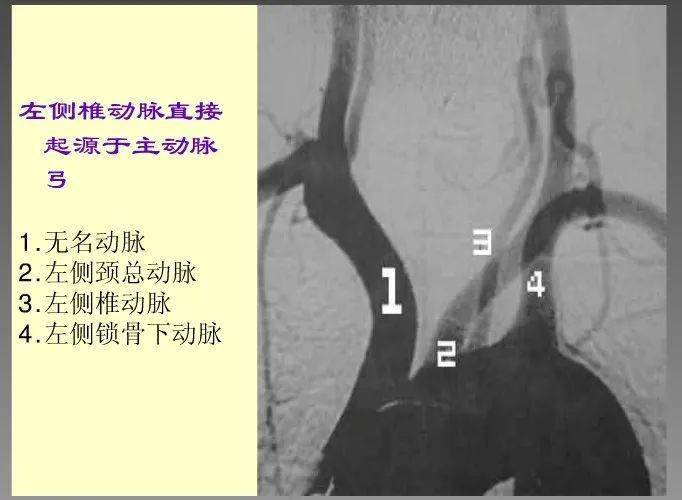 轻松看懂脑血管造影