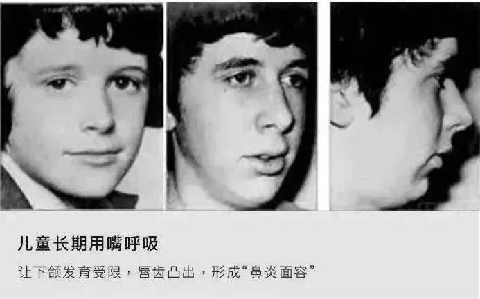 已经束手无策 而鼻炎对儿童的危害更大 如果因鼻腔堵塞而长期用嘴呼吸