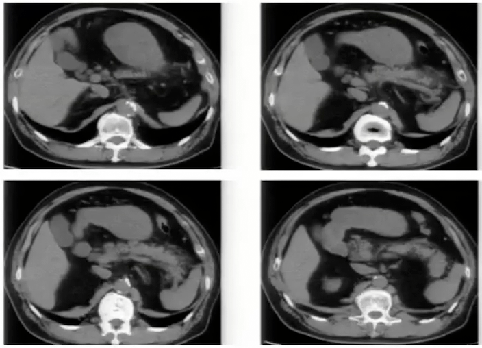 胰腺|看得懂这些腹部CT，主任一定对你刮目相看！