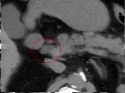 胰腺|看得懂这些腹部CT，主任一定对你刮目相看！