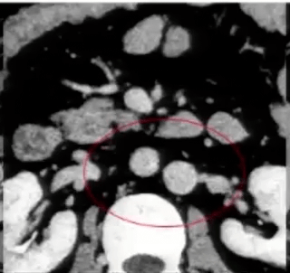 胰腺|看得懂这些腹部CT，主任一定对你刮目相看！