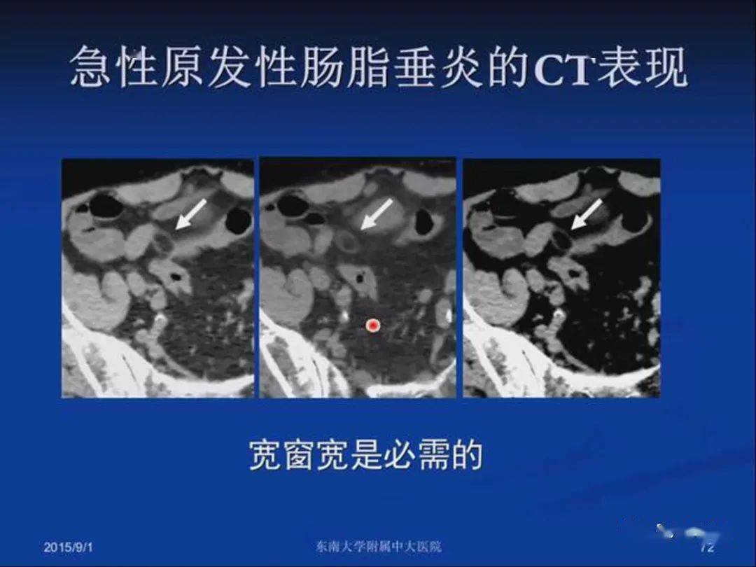 急性原发性肠脂垂炎影像诊断