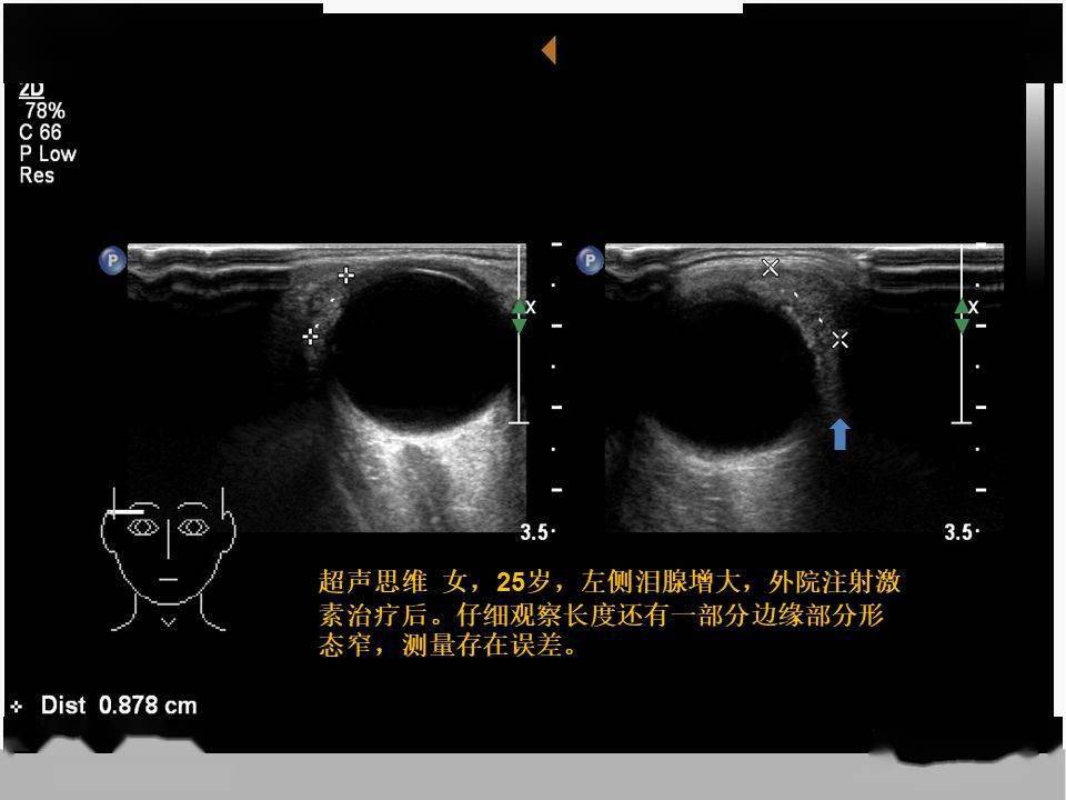 超声时间 泪腺-需要重新审视的器官_手机搜狐网