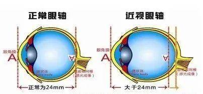 手术治疗近视是什么原理_近视激光手术原理图解