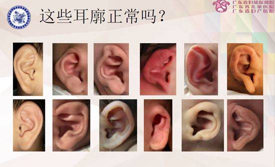 耳廓|宝宝耳廓不正常多拉拉就好?专家:应尽早矫正