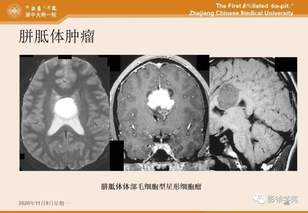 5类胼胝体病变的影像学表现