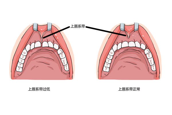位于口腔前庭上,中切牙之间,牙龈与粘膜交界处,呈扇形或带状的粘膜