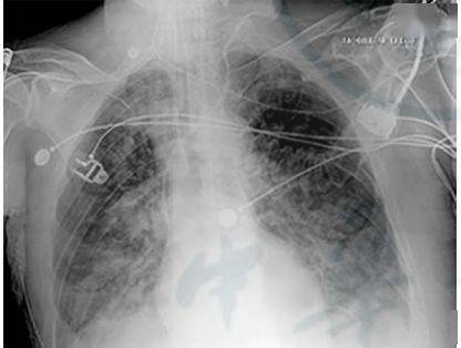 患者|相关知识 | 急性呼吸窘迫综合征（ARDS）：图文详解