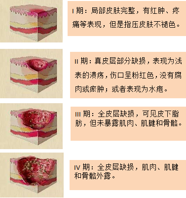 上图压疮的分期根据病情发现阶段，压疮大致可分为四期，症状特点如下：