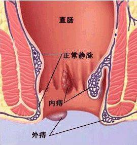 疾病科普丨十女十痔,为何痔疮青睐女性?