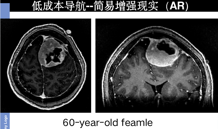 混合|佳品有约 |研发头戴式混合现实导航等技术助力基层神外实现精准手术 - 陈晓雷许百男