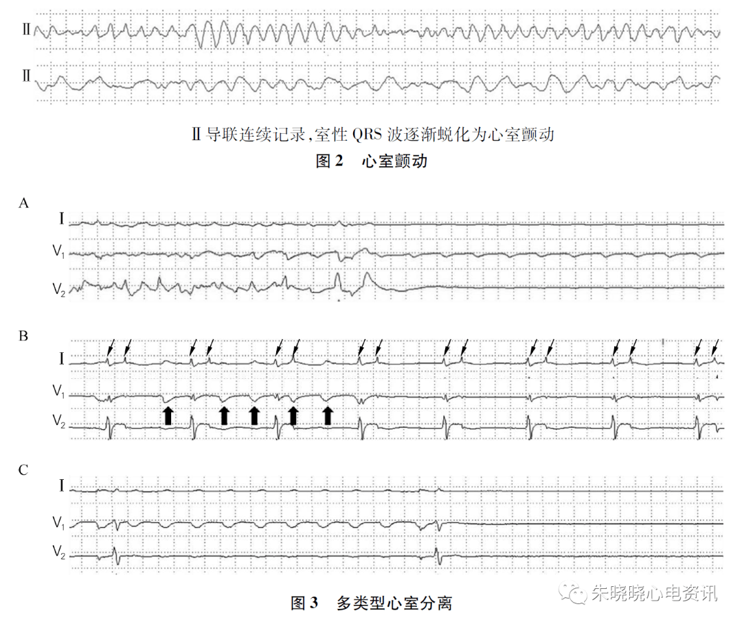 病例分享 罕见的多类型心室分离_心电图