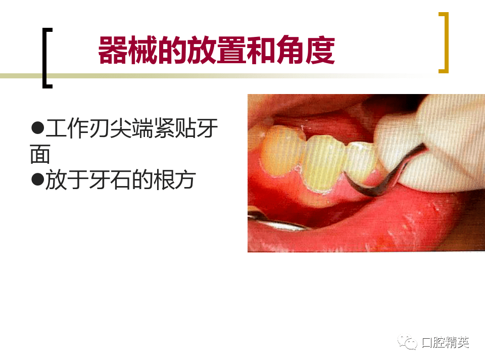 龈上洁治术