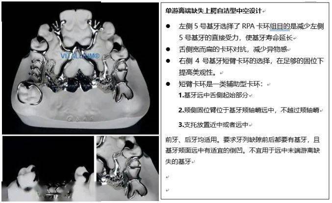 维他灵支架-应力中断的概念与原理