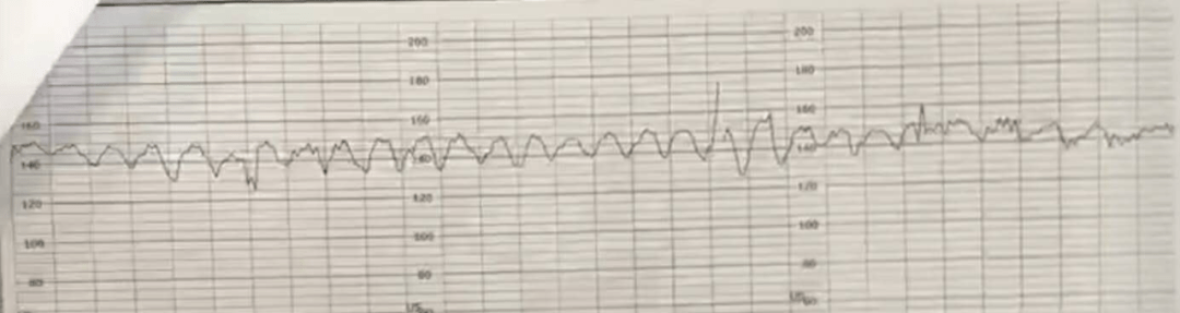 胎监显示正弦波形,新生儿血红蛋白仅 30 g/l,原因为何