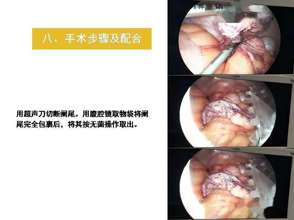 【ppt】腹腔镜阑尾切除术围术期的护理